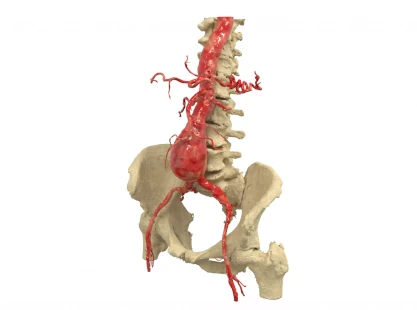 Imagen de estructuras virtuales tridimensionales de la cadera y una aorta abdominal texturizadas